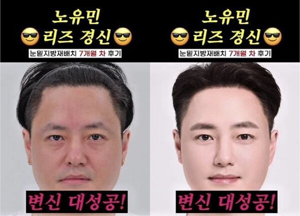 'Leeds Renewal' Noh Yu -min, hair transplantation, and the late relocation of the local relocation is released 